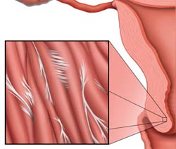 Painful Intercourse A diagram of adhesions