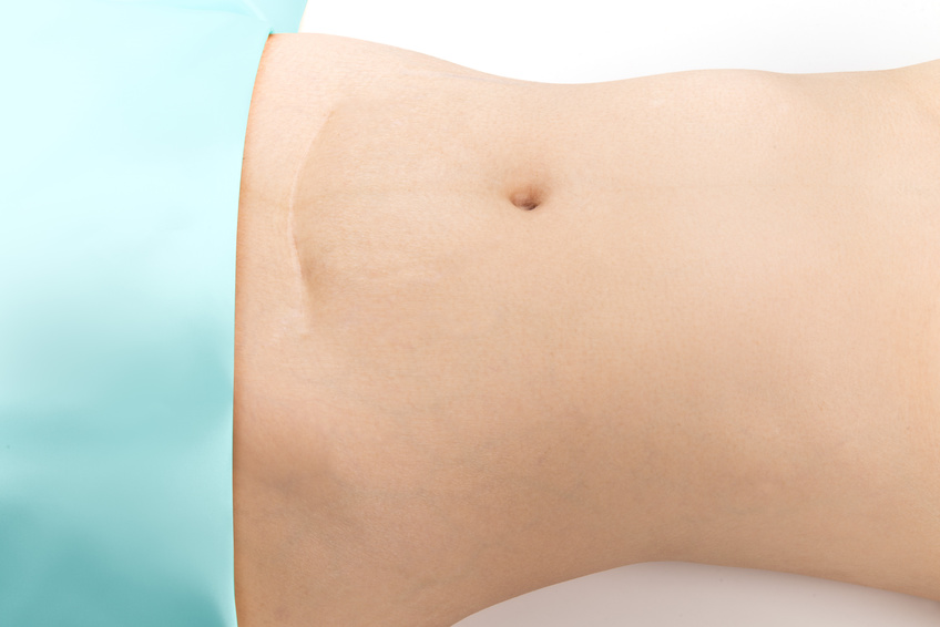 depressed c-section scars can give an insight to post surgical c-section adhesions